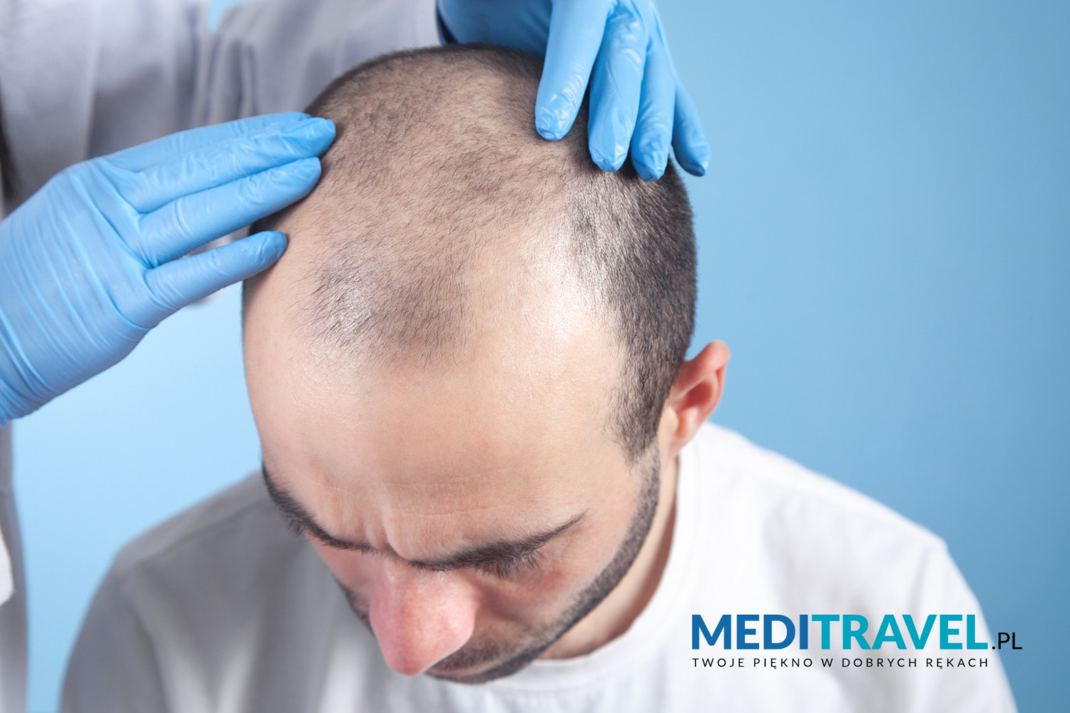 Facts And Myths About Hair Transplantation Meditravel