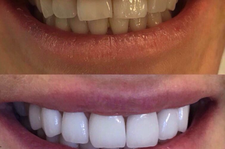 Dentistry - Hollywood Smile