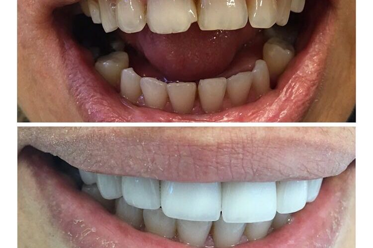 Dentistry - Hollywood Smile