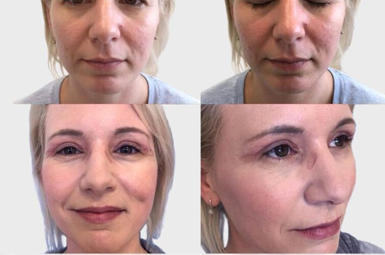 Facelifting before and after