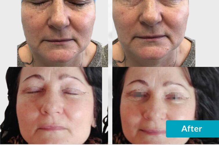 Facelifting before and after