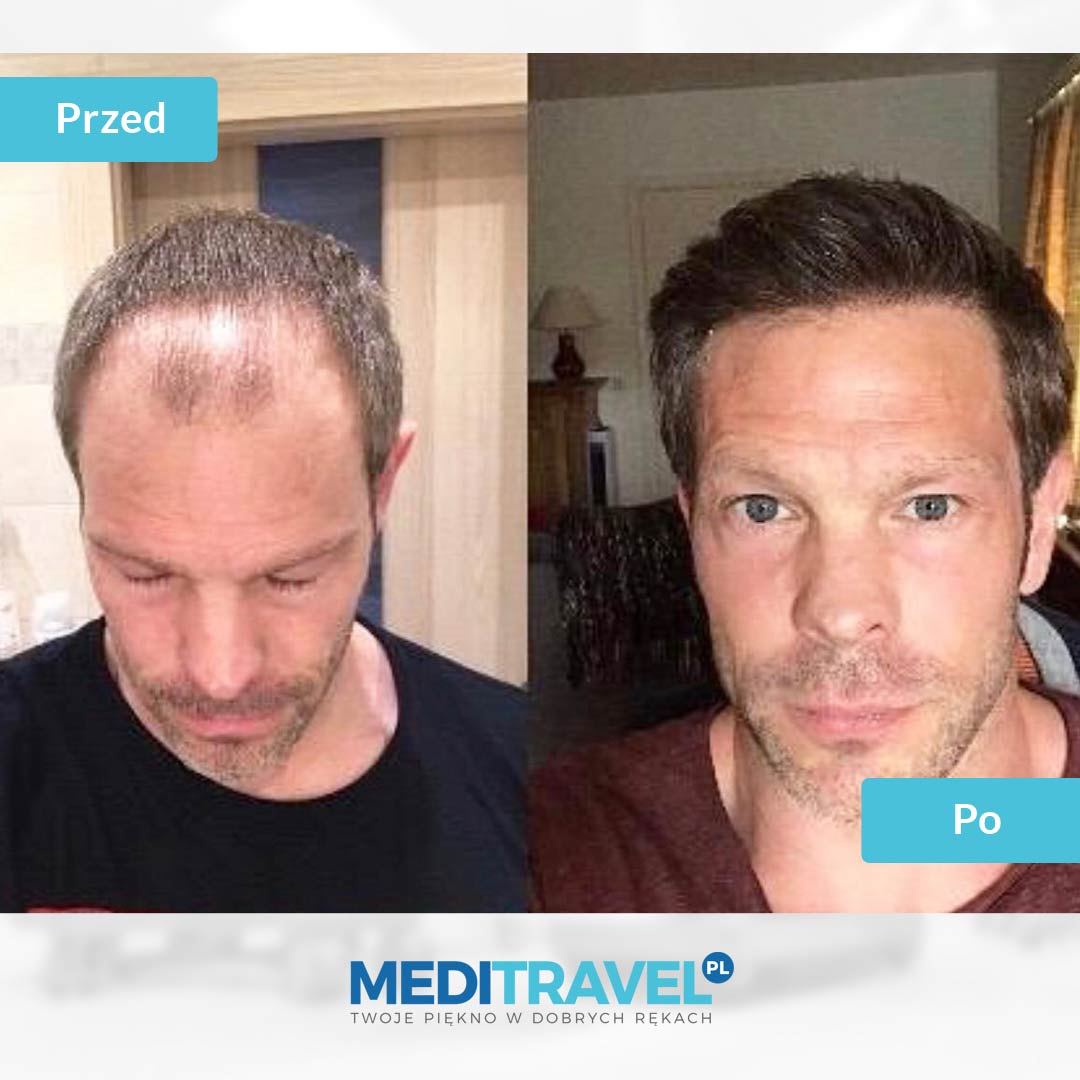 Hair transplant - before and after