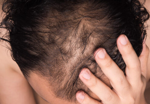 How to recognize signs of baldness