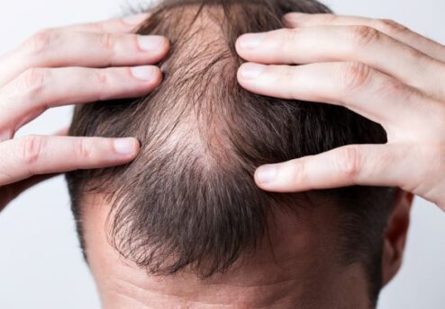 Diseases that cause hair loss