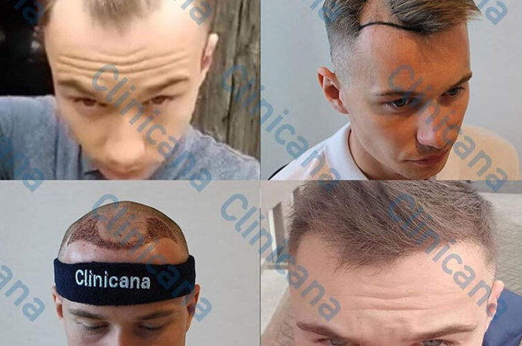 Hair transplant in Turkey - before and after