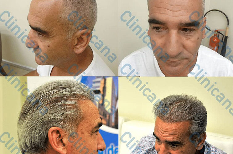 Hair transplant in Turkey - before and after