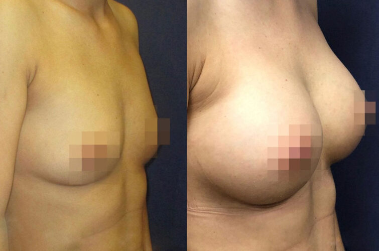 Breast enlargement operation surgery