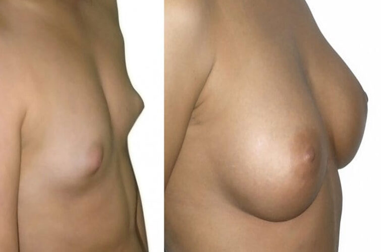 Breast enlargement operation surgery
