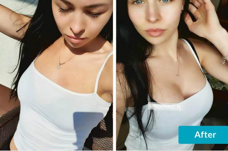 Breast enlargement surgery - before and after