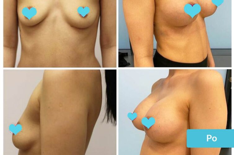 Breast enlargement surgery - before and after