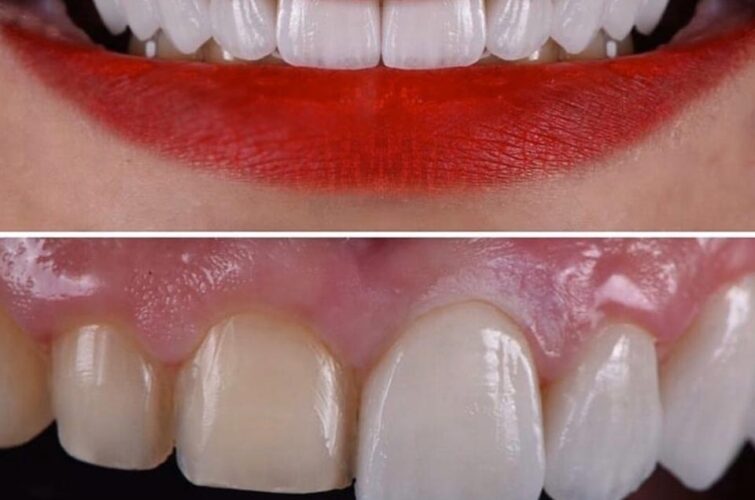 Dentistry Hollywood smile - before and after
