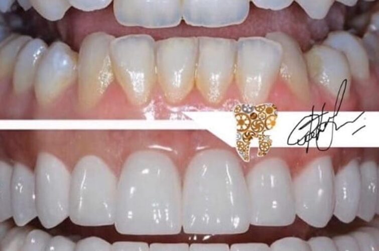 Dentistry Hollywood smile - before and after