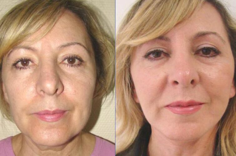 Faceliftig before and after
