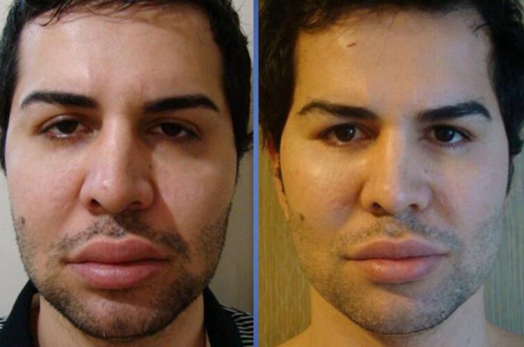 Faceliftig before and after