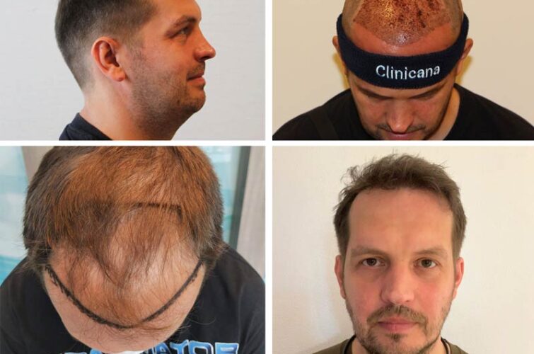Hair transplant - before and after