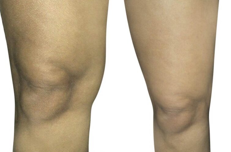 Liposuction - before and after