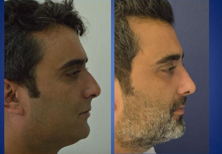 Nose surgery - Rylanoplasty - before and after