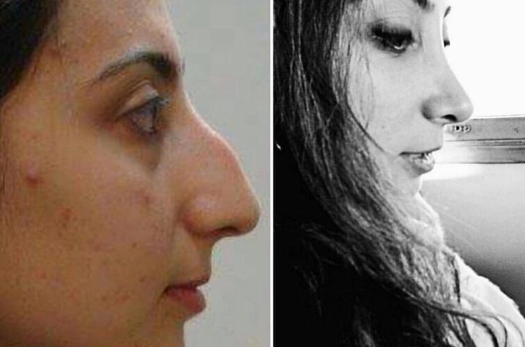 Nose surgery - Rylanoplasty - before and after