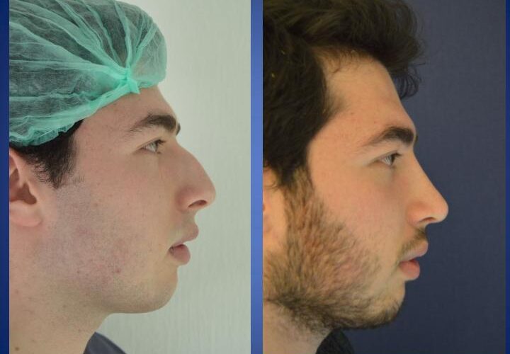 Nose surgery - Rylanoplasty