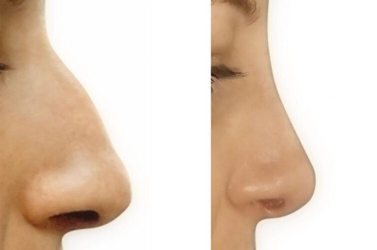 Rhinoplasty nose surgery - before and after