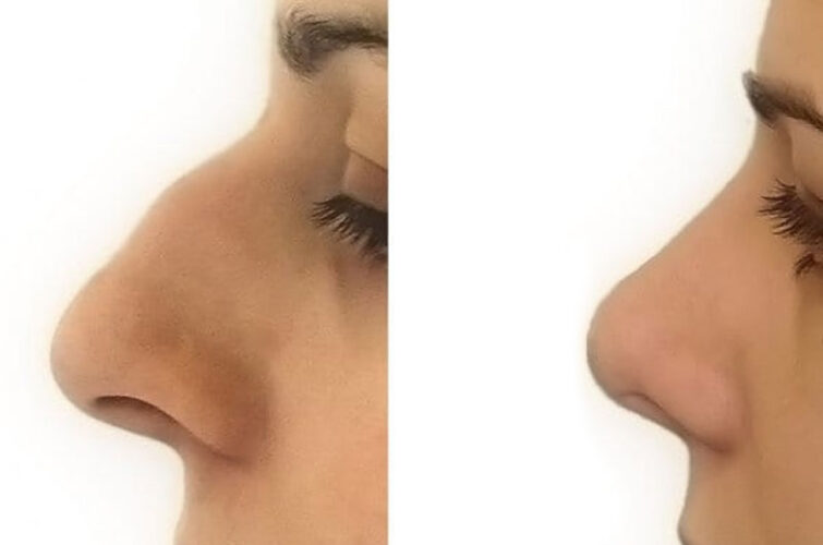 Rhinoplasty nose surgery - before and after