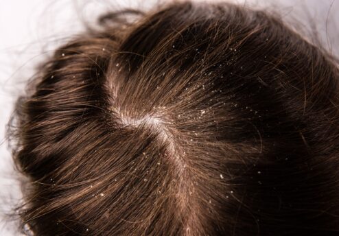 Did the dandruff causes hair loss