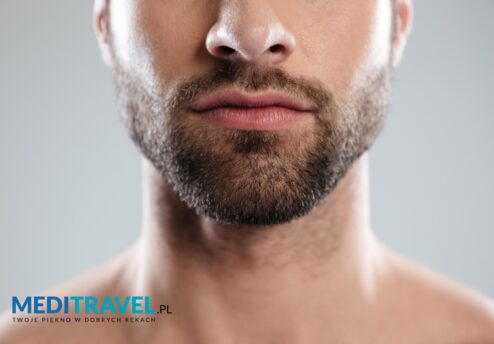 beard graft transplant